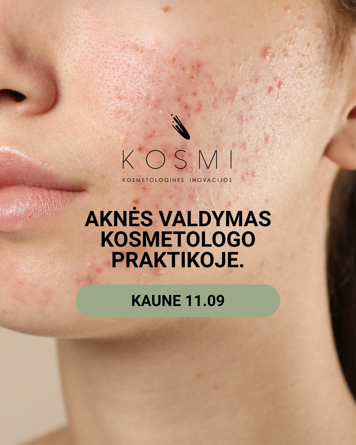 AKNĖS VALDYMAS KOSMETOLOGO PRAKTIKOJE KAUNE 11.09
