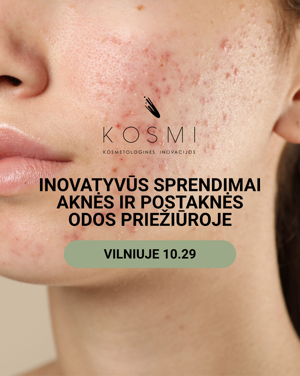 INOVATYVŪS SPRENDIMAI AKNĖS IR POSTAKNĖS ODOS PRIEŽIŪROJE VILNIUJE 10.29
